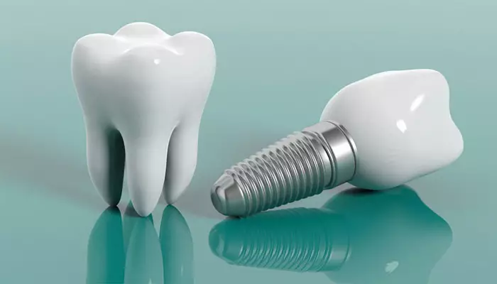 بهترین ایمپلنت دندان کدام است؟